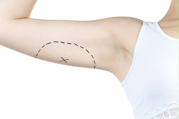 Chirurgie de lifting des bras (brachioplastie) chez EsteCenter Istanbul