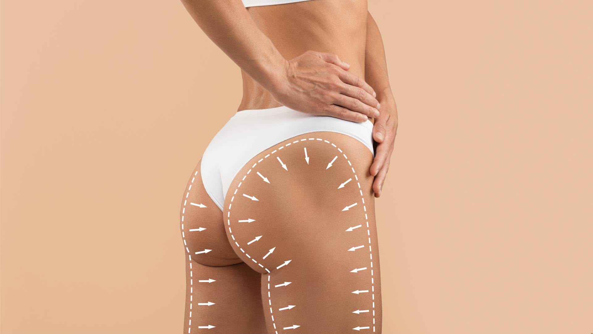 Chirurgie Brazilian Butt Lift (BBL) chez EsteCenter Istanbul