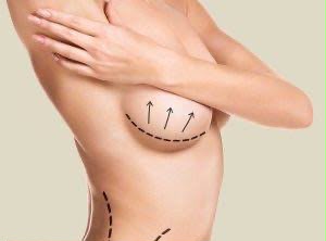 Chirurgie de lifting mammaire (mastopexie) chez EsteCenter Istanbul