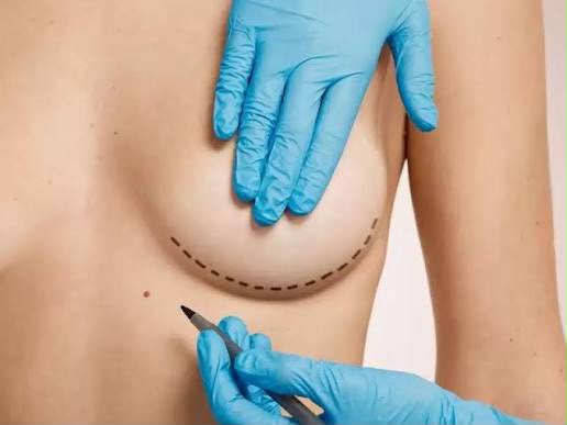 Chirurgie de réduction mammaire chez EsteCenter Istanbul
