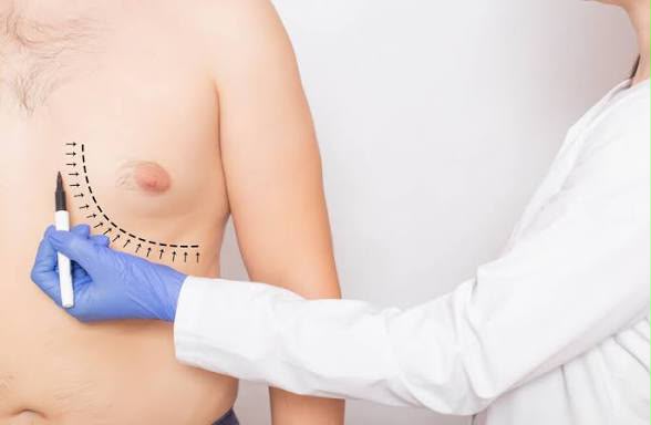 Chirurgie de gynécomastie (poitrine masculine) chez EsteCenter Istanbul