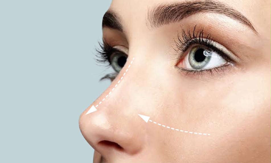 Septorhinoplastie combinant remodelage du nez et correction des voies respiratoires chez EsteCenter Istanbul