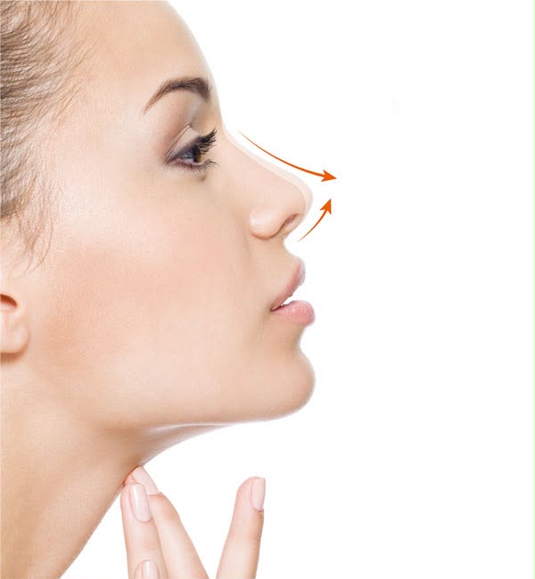 Rhinoplastie de la pointe affinant la pointe nasale chez EsteCenter Istanbul