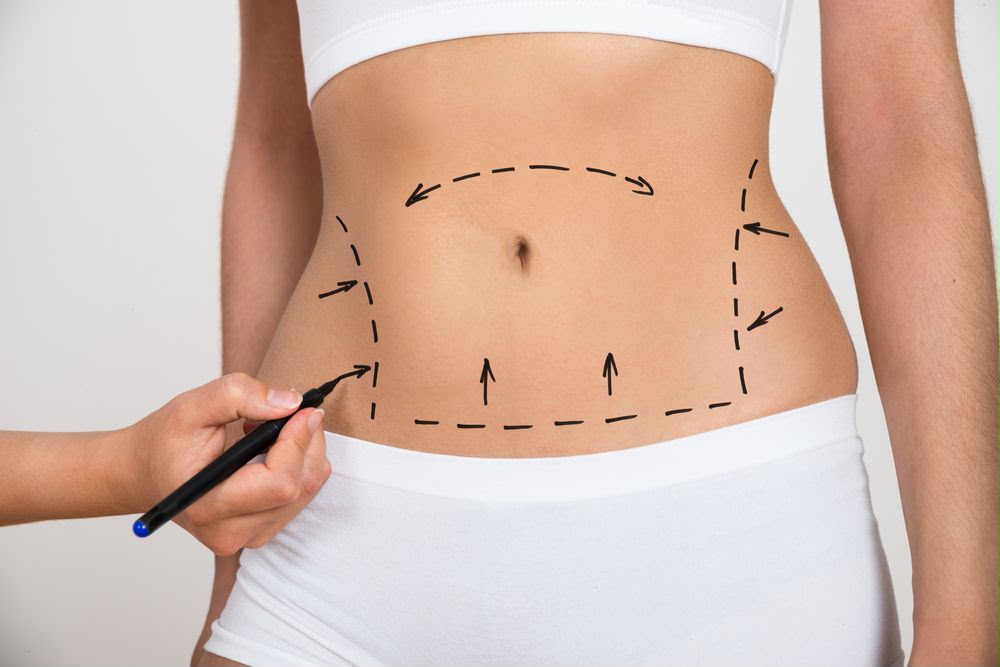 Chirurgie d'abdominoplastie chez EsteCenter Istanbul