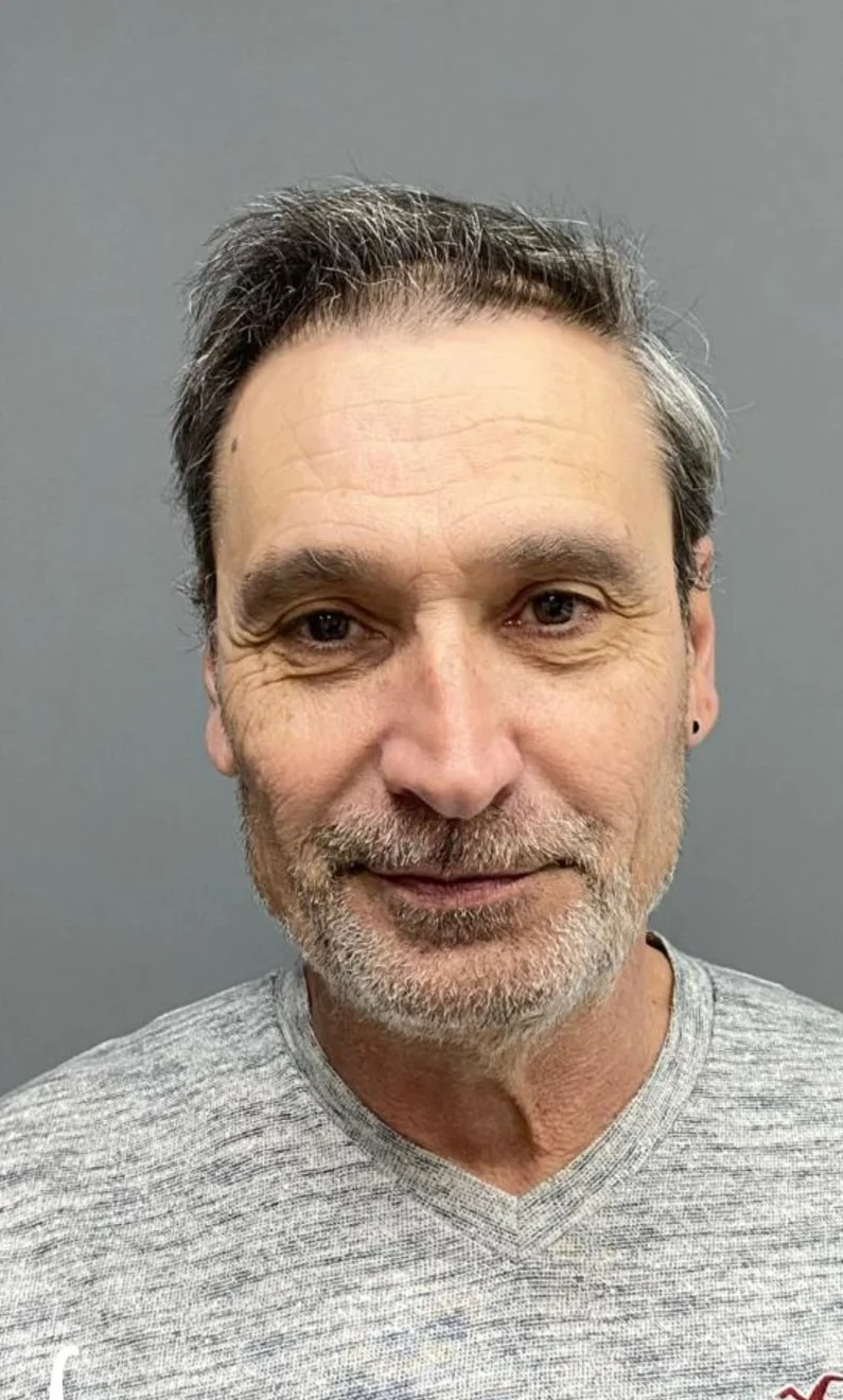 Résultat après greffe de cheveux