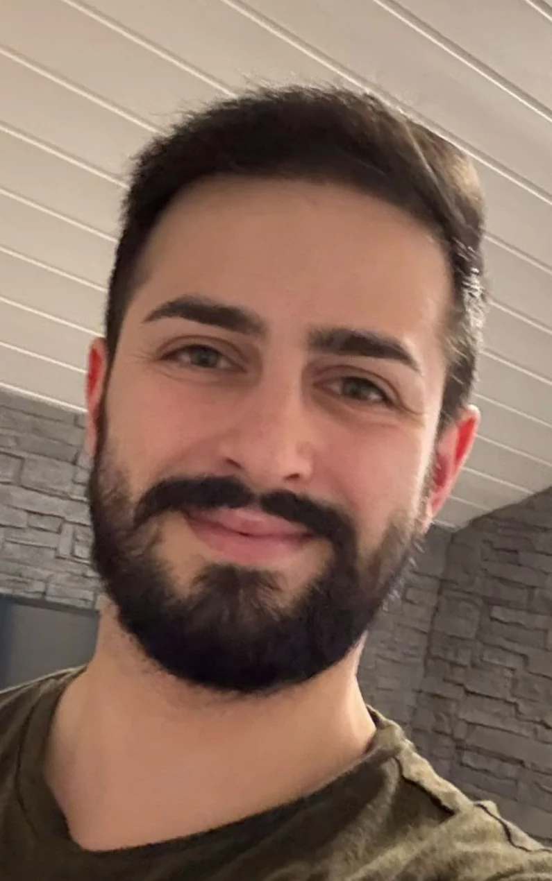 Résultat après greffe de cheveux