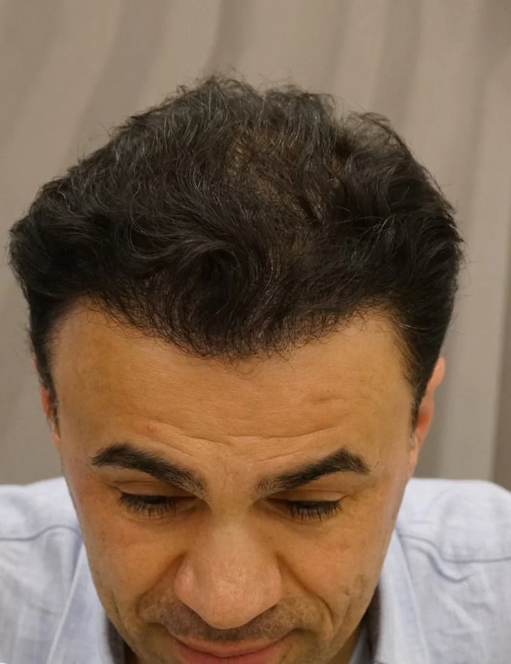 Résultat après greffe de cheveux