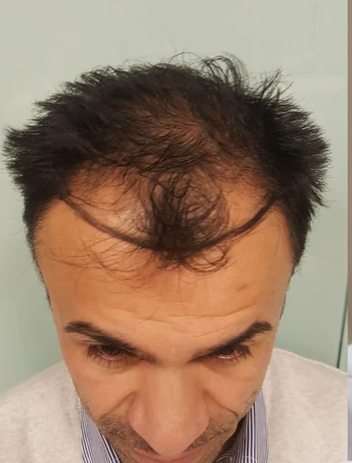 Avant la greffe de cheveux