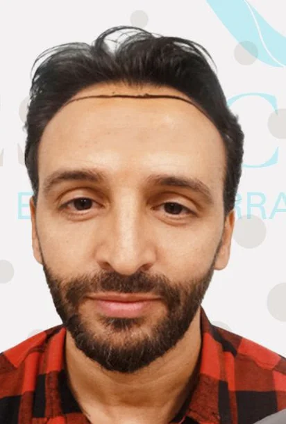Avant la greffe de cheveux