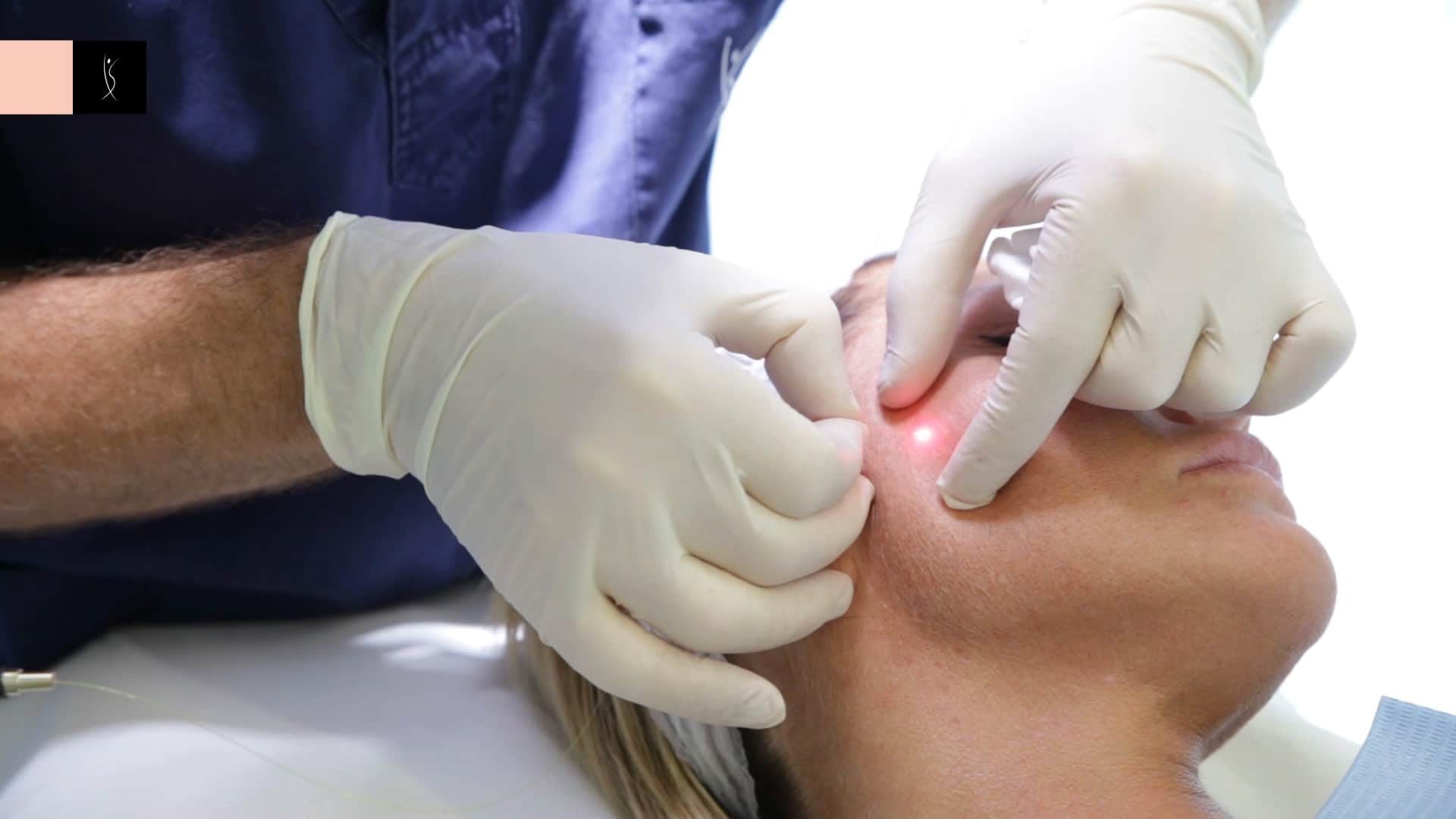 Lifting du visage au laser Endolift chez EsteCenter Istanbul