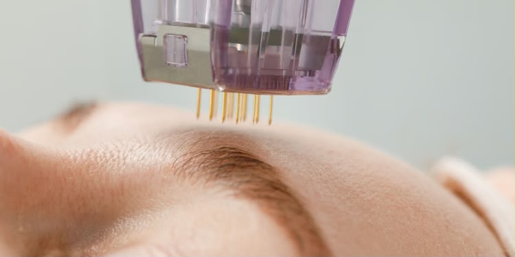 Microneedling par radiofréquence aiguille dorée Scarlet X chez EsteCenter Istanbul