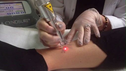 Traitement cutané au laser Mydon chez EsteCenter Istanbul