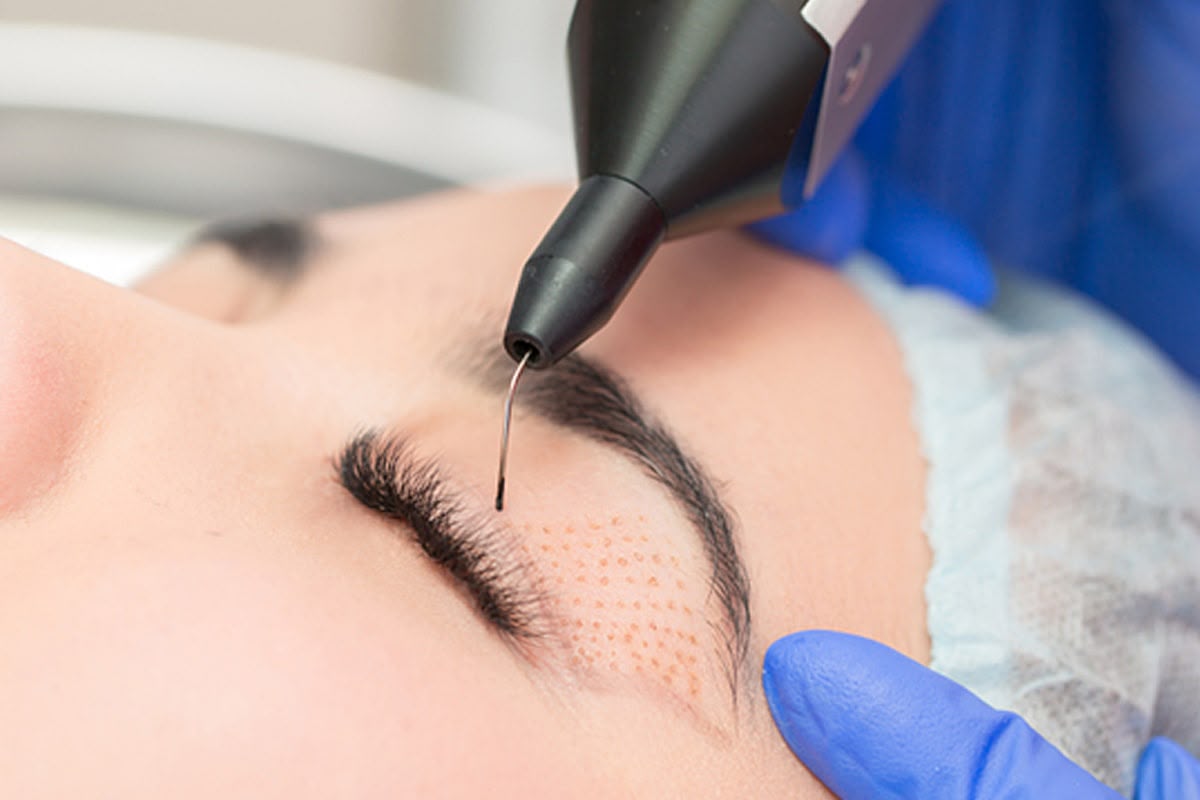 Chirurgie douce au plasma Plexr chez EsteCenter Istanbul