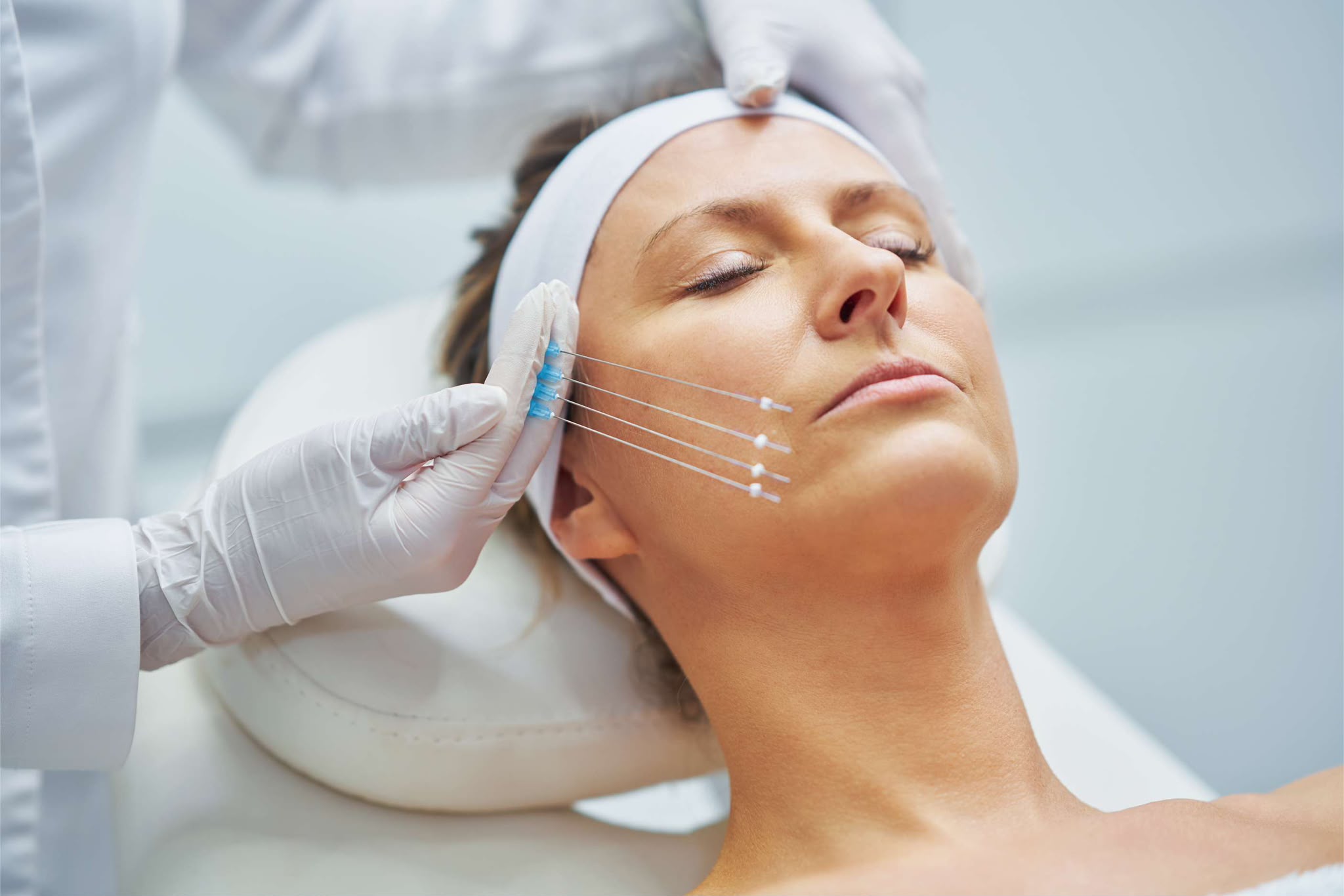 Lifting du visage par fils PDO chez EsteCenter Istanbul