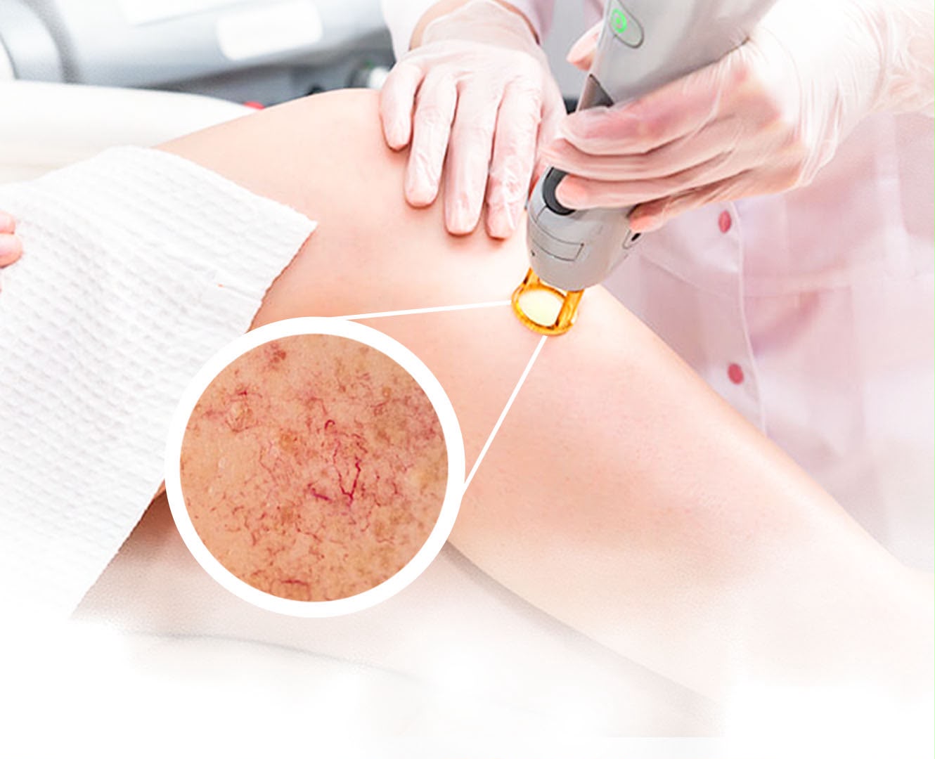 Traitement au laser vasculaire des capillaires chez EsteCenter Istanbul